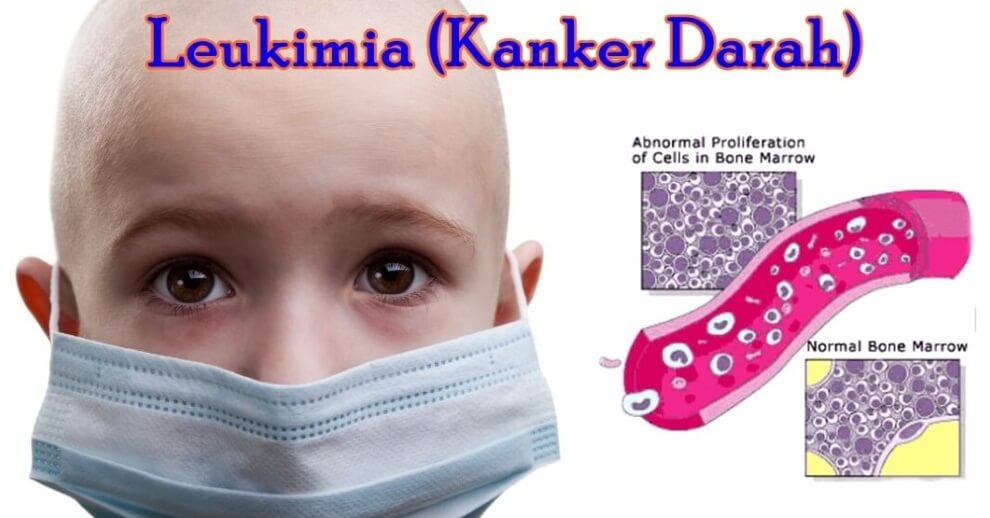 AYAH BUNDA SELAMATKAN ANAK DARI LEUKIMIA AYAH BUNDA SELAMATKAN ANAK DARI LEUKIMIA