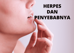 herpes dan penyebabnya