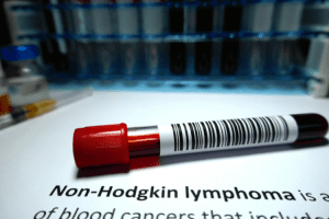 kanker kelenjar getah bening Limfoma Non Hodgkin (LH)