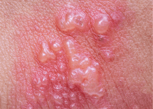 komplikasi penyakit herpes