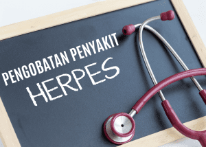 pengobatan penyakit herpes