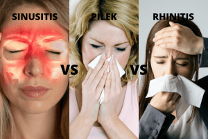 perbedaan sinusitis pilek dan rhinitis